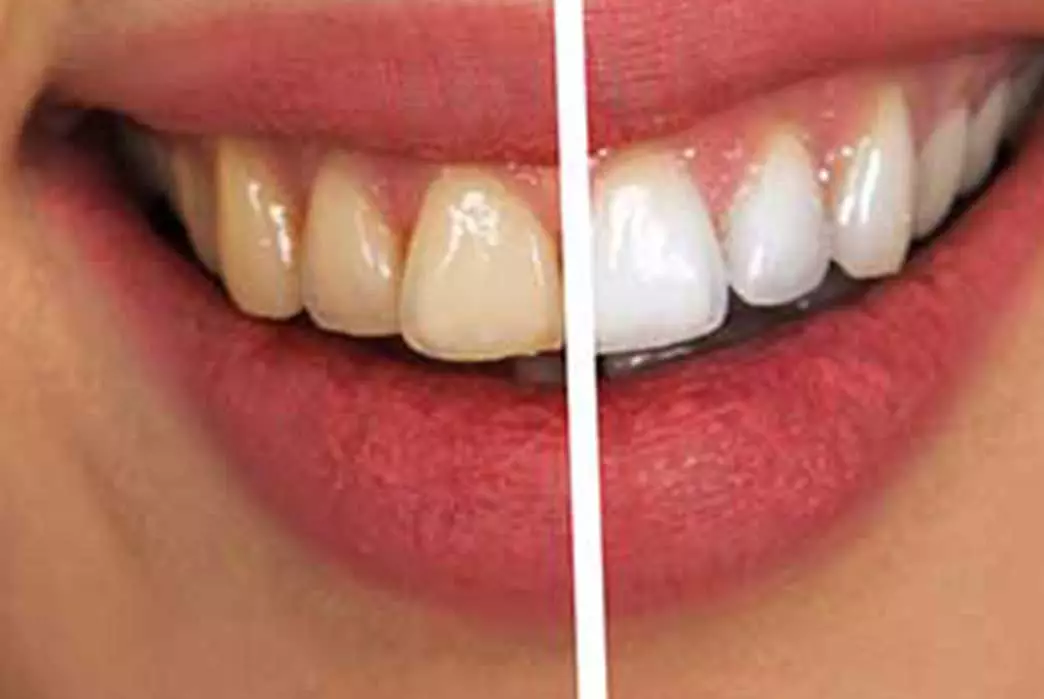 service teeth whitening